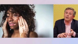 Imagem de Vitiligo