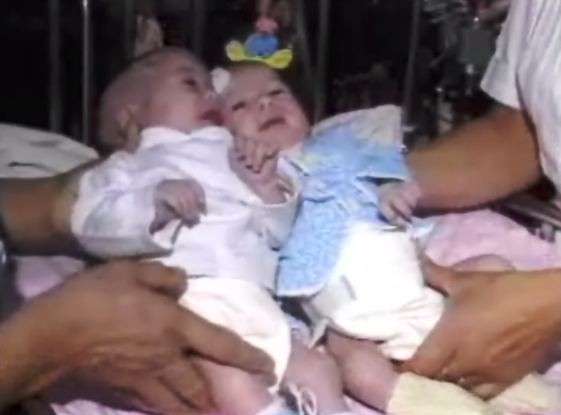 Estado de Saúde das Gémeas Siamesas