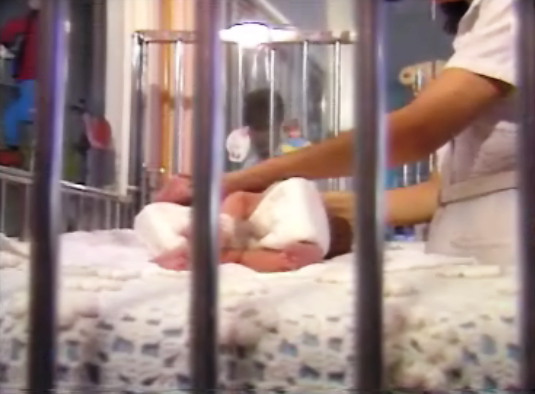 Preparativos para a separação das gémeas siamesas