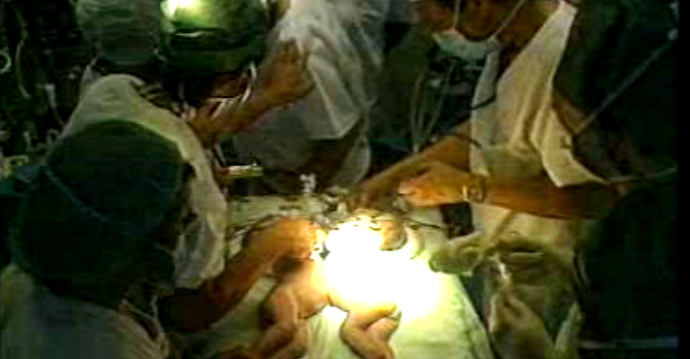 Separação de gémeas siamesas