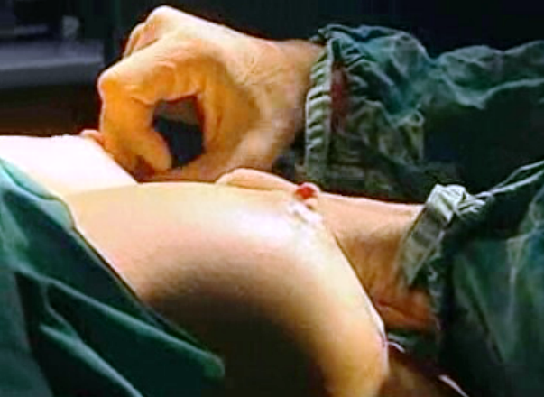 Implantes mamários retirados do mercado