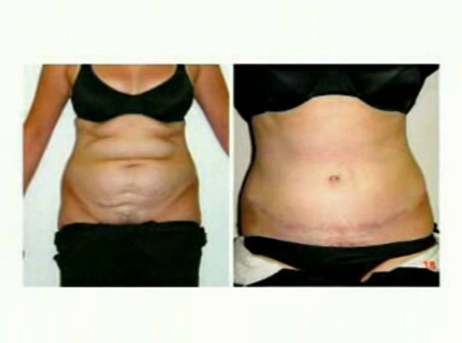 Aumento de cirurgias plásticas em Portugal