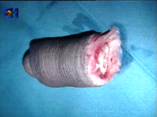 Reimplantação de pénis