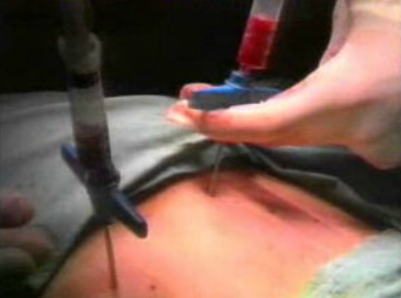 Doação de medula a vítima de Chernobyl