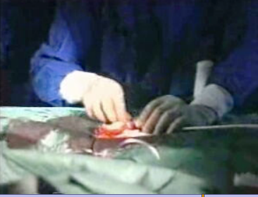 Nova técnica de cirurgia ao coração