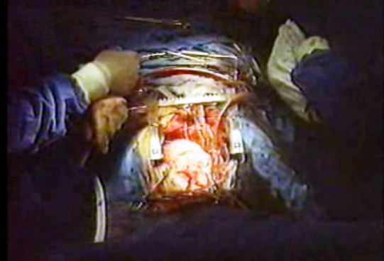 Transplante e doação de órgãos