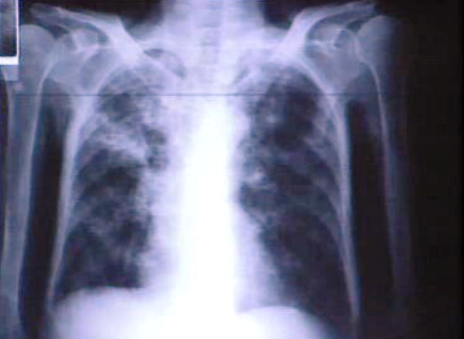 Aumento de cancro do pulmão