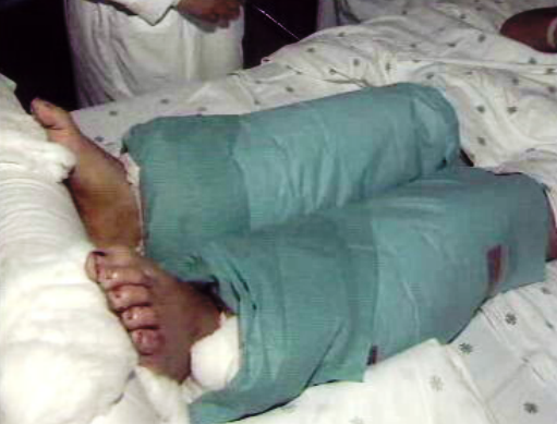 Hospital de São João efetua reimplante de pernas