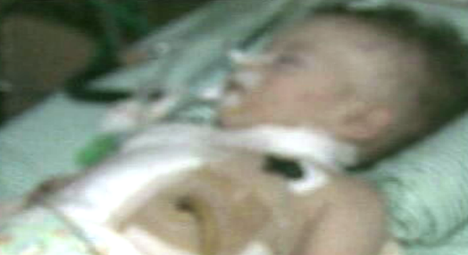 Bebé operado ao esófago