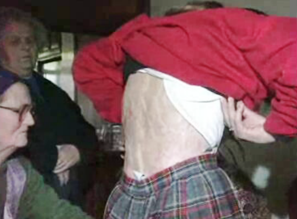 Caso da criança queimada