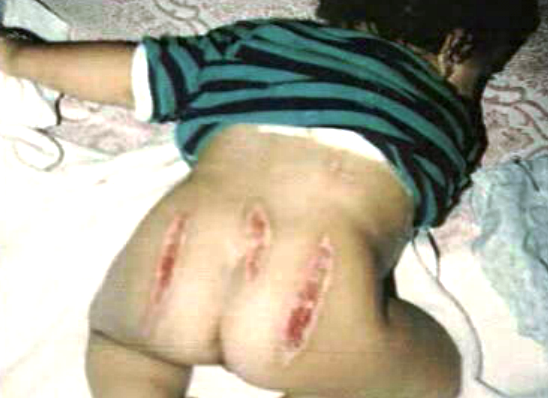 Caso da criança queimada