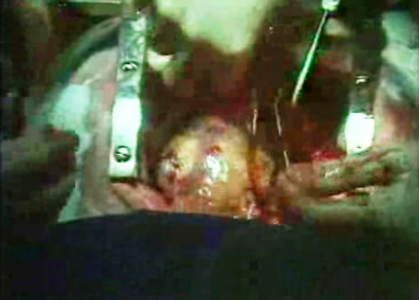 Operação cirúrgica de coração aberto