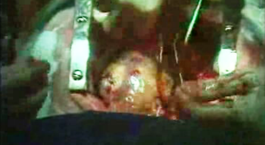 Operação cirúrgica de coração aberto