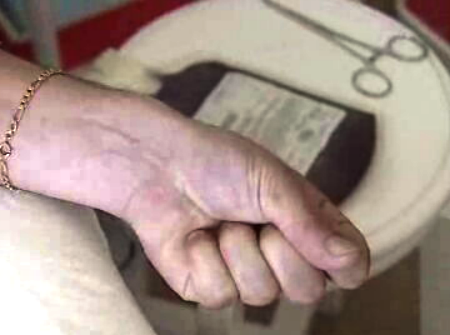 Excesso de dadores de sangue