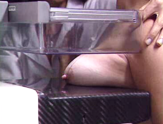 Rastreio ao cancro da mama