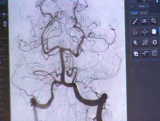 Novo tratamento para o aneurisma