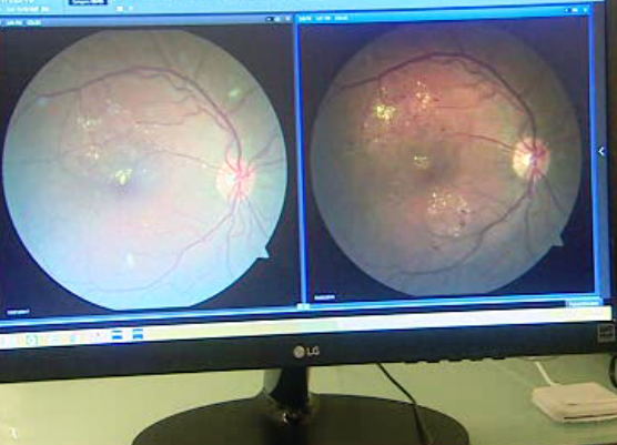 Retinopatia diabética na Madeira