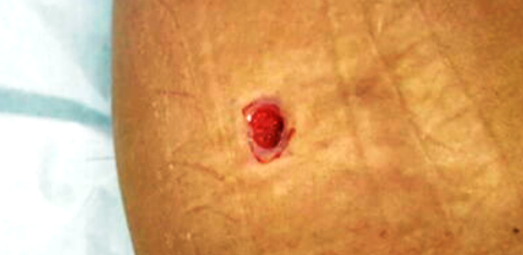 Perigos da lipoaspiração