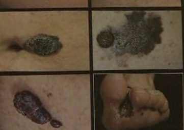 Aumento dos cancros de pele