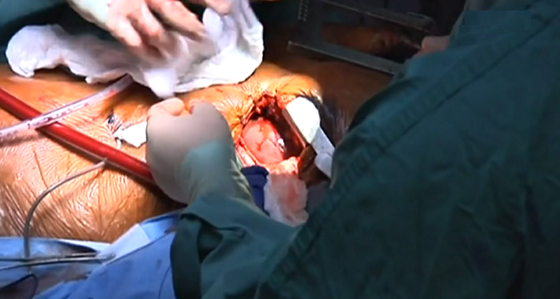 Primeiro coração artificial definitivo