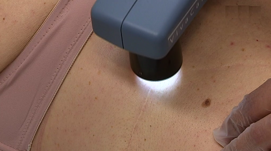 Rastreios no Dia Europeu do Melanoma