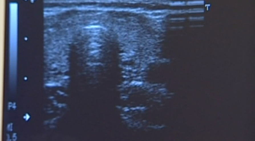 Doença da Tiroide em Portugal