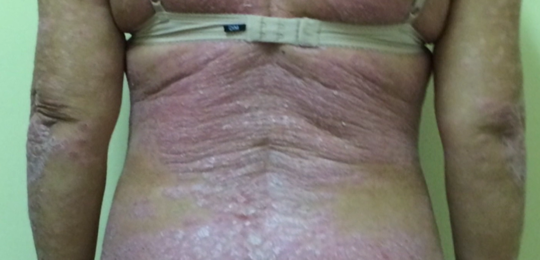 Dia Mundial da Psoríase