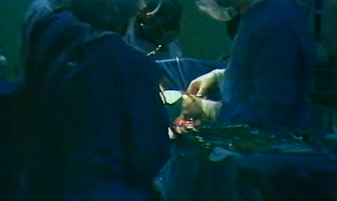 Transplante cardíaco no Hospital de Santa Cruz