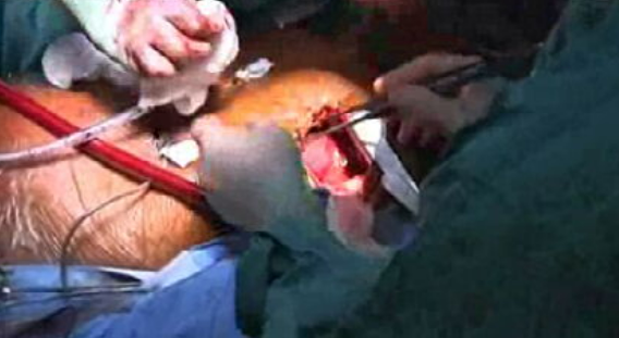 Coração artificial