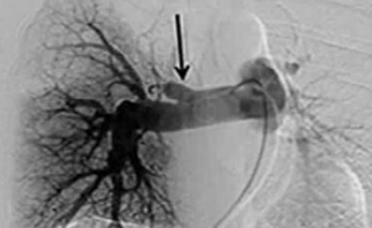 Hipertensão Pulmonar