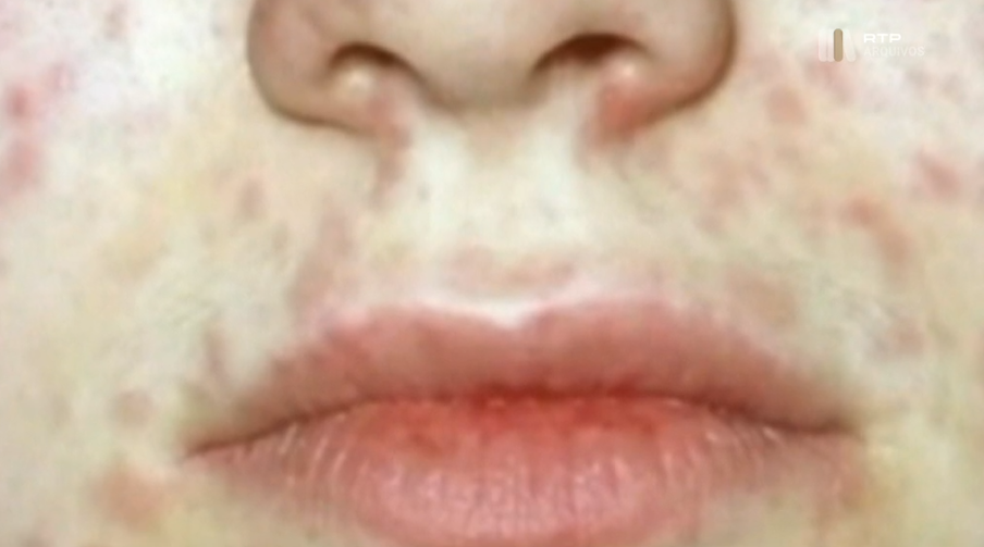 Imunidade ao sarampo em Portugal