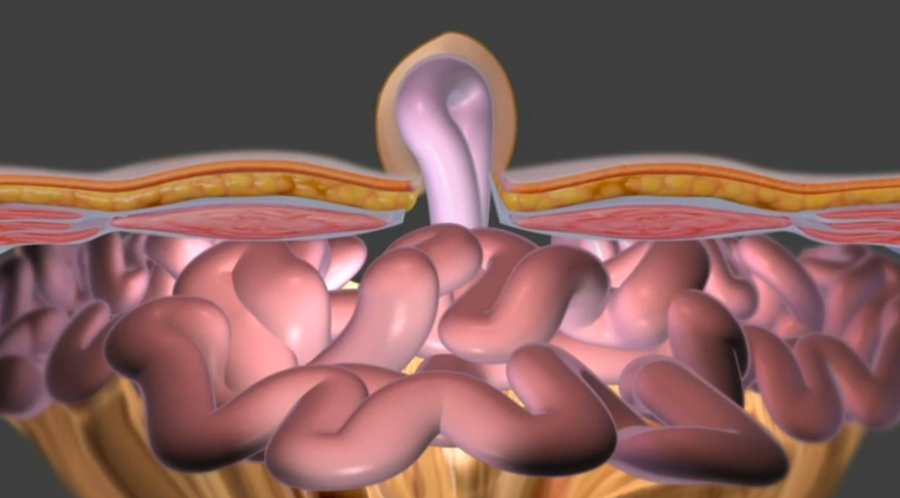 Hérnias umbilicais