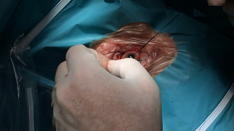 Tratamento de tumores oculares no Centro Hospitalar de Coimbra