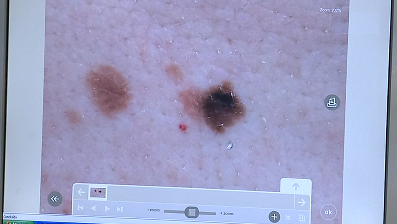 Alerta para o cancro cutâneo