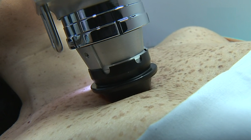 Rastreio do cancro da pele