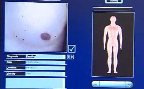 Dia do melanoma