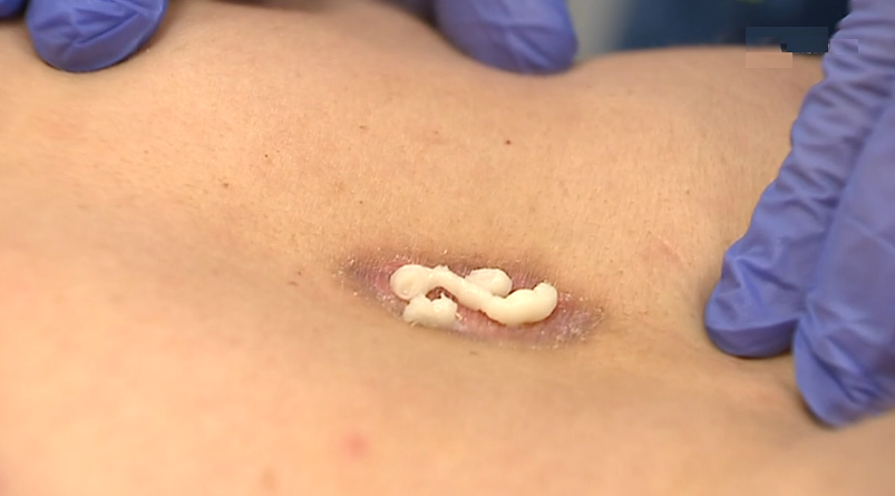 Tratamento inovador do cancro da pele