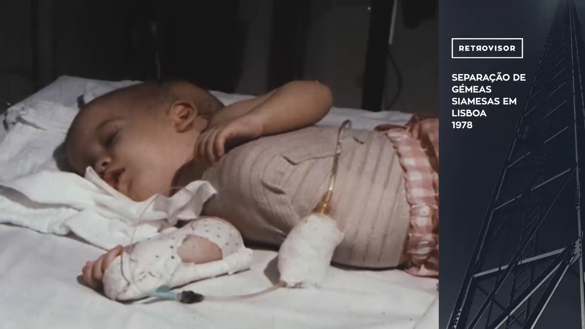 Separa��o de G�meas Siamesas em Lisboa