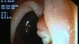 Imagem de Madeira regista 180 novos casos de cancro do cólon por ano (vídeo)