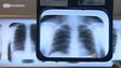 Imagem de Médicos recomendam vacinação contra pneumonia a idosos com patologias respiratórias (Vídeo)