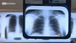Médicos recomendam vacinação contra pneumonia a idosos com patologias respiratórias (Vídeo)