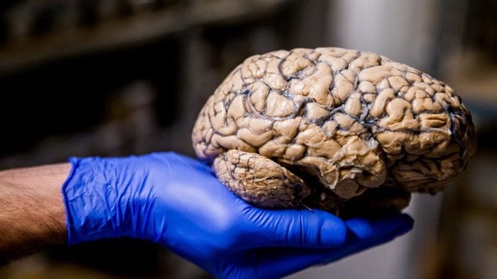 Imagem de Desequilíbrio do pH no cérebro pode ser causa de Alzheimer