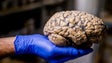 Desequilíbrio do pH no cérebro pode ser causa de Alzheimer