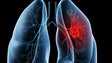Madeira regista cerca de 70 novos casos de cancro do pulmão