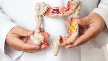 Imagem de Mais de uma centena de novos casos de cancro colorretal (áudio)