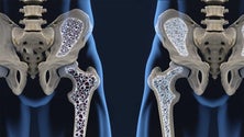 Imagem de Osteoporose afeta 800 mil portugueses