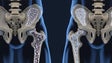 Imagem de Osteoporose afeta 800 mil portugueses