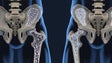 Osteoporose afeta 800 mil portugueses