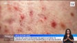 Imagem de Há um novo surto de «MPOX» em Portugal (vídeo)