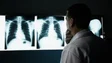 Imagem de Campanha alerta para importância de diagnóstico precoce na fibrose pulmonar